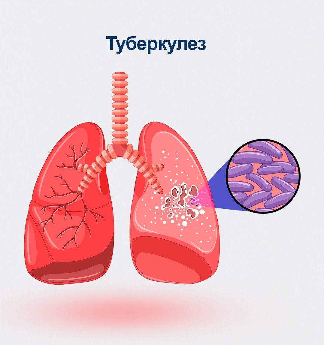 Туберкулез